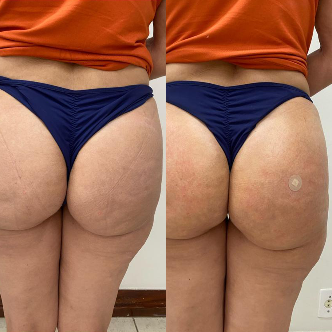 Antes e depois de procedimento estético corporal